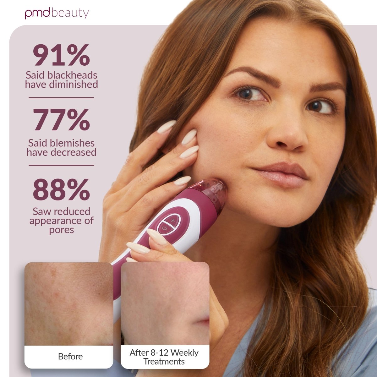 Sistema de cuidado de la piel en casa Personal Microderm Elite Pro