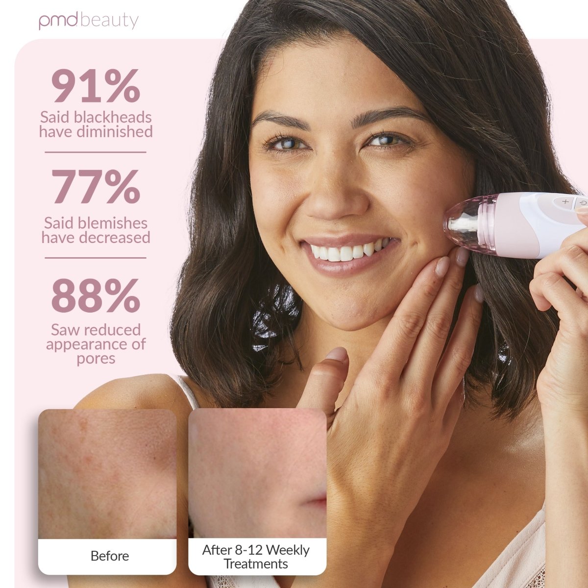 Sistema de cuidado de la piel en casa Personal Microderm Elite Pro