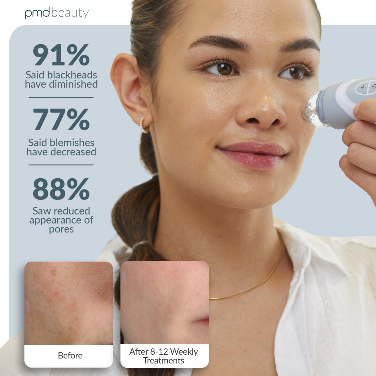 Sistema de cuidado de la piel en casa Personal Microderm Elite Pro
