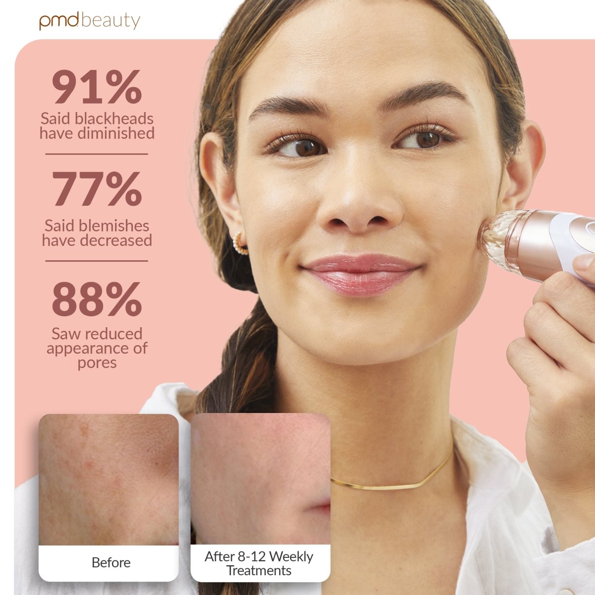 Sistema de cuidado de la piel en casa Personal Microderm Elite Pro