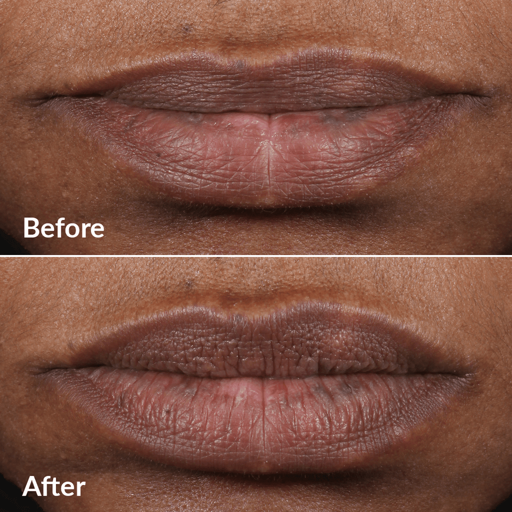 Sistema PMD Kiss – Kit de belleza profesional para usar en casa