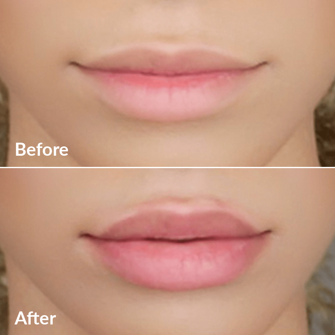 Sistema PMD Kiss – Kit de belleza profesional para usar en casa