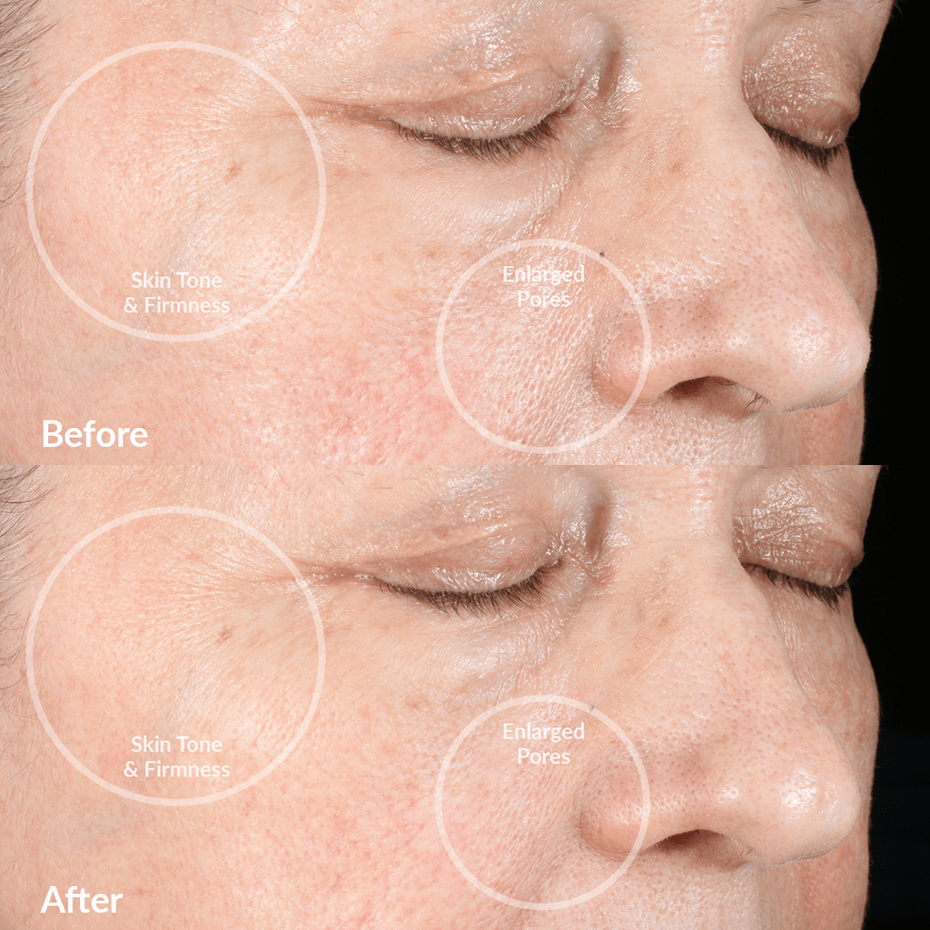 Dispositivo de limpieza facial PMD Clean Pro RQ