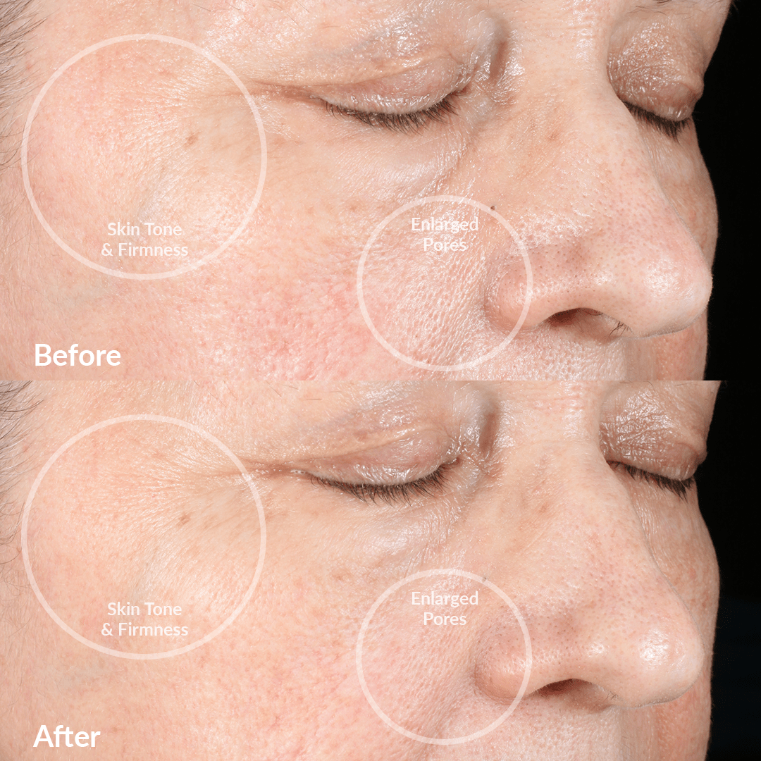 Dispositivo de limpieza facial PMD Clean Pro RQ